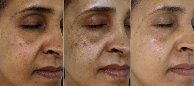 Age-Spots