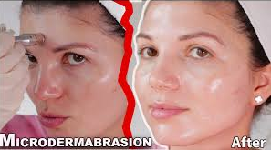 Microdermabrasion Before and After